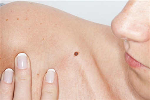 mole evaluation and removal