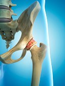When Do you Need Hip Replacement Surgery to correct hip pain