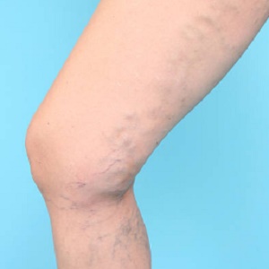 What Are Treatment Options for Varicose Veins?