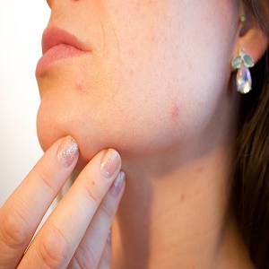 How can I improve acne scars?