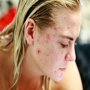 How to effectively get rid of acne?