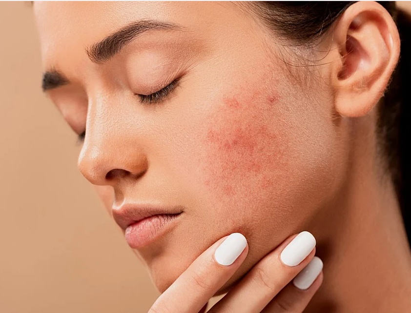 How Can I Treat Deep Acne Scars?