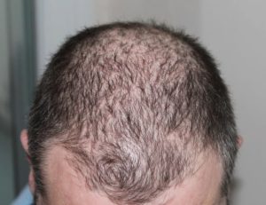 How Can I Restore my Hair?